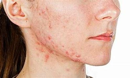 Acne at my age