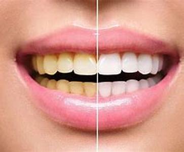 Teeth Whitening Gels
