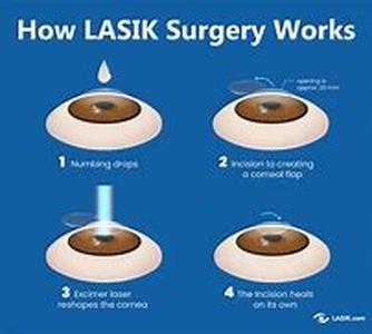 Lasik Financing