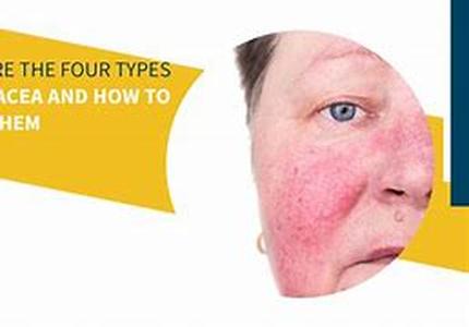 Treating Fever with Generic Drugs