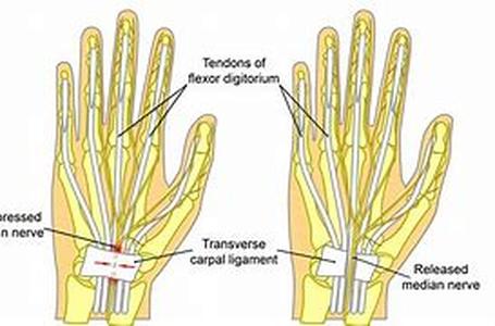 Carpal Tunnel Massage