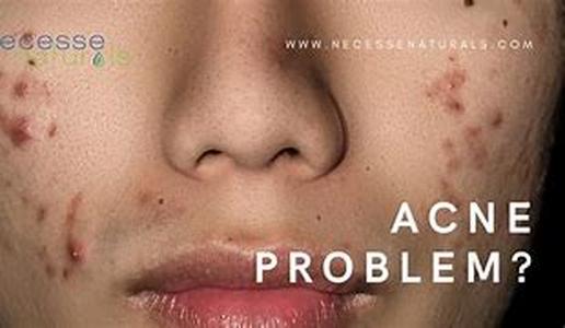 Acne Treatment: Ten Facts about Acne