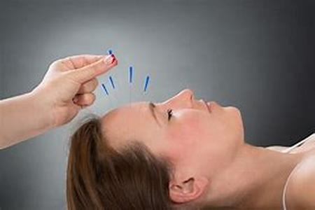 Acupuncture Can Help Treat Migraines