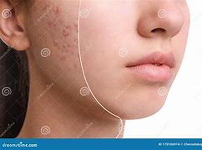 Acne and Diet - Insulin, Insulin Resistance, and Hormones