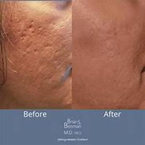 Acne- Why It Forms More During Adolescence