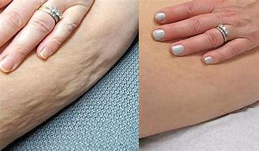 Celiac Disease and Diabetes