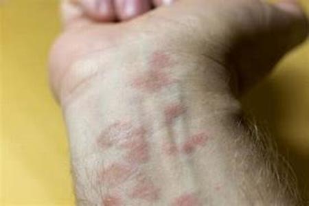 Eczema - Instigator The Itch