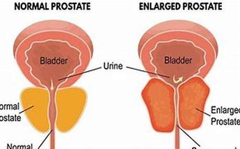 Prostate Cancer Treatment Options  A modern mans greatest fear when he gets old is not senility but prostate cancer