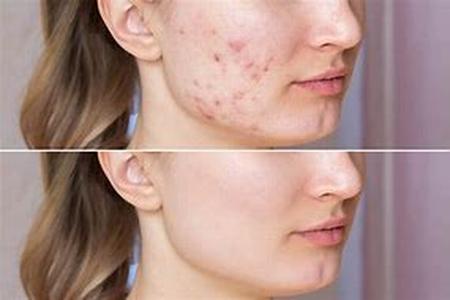 Causes of Adult Acne