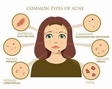 What Exactly Is Psoriasis