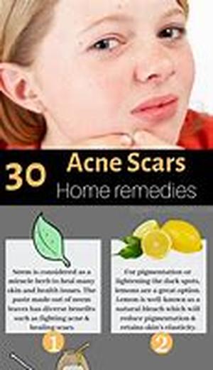 Acne Medication - Research of Side Affects