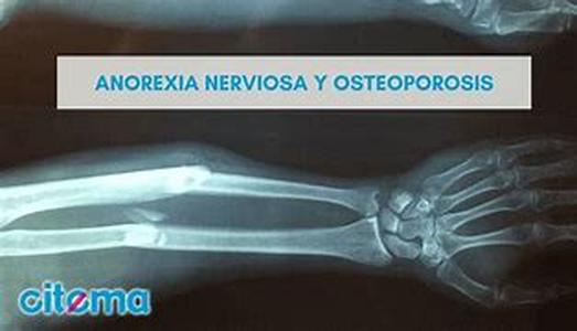 Osteoarthritis