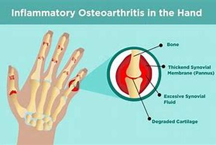 Arthritis for old age