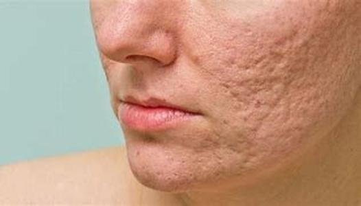 Acne Program  Step 7  Fruits You Should Eat