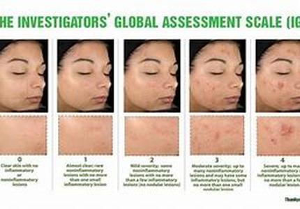 Acne - Know About Whiteheads And Blackheads For Clear Skin