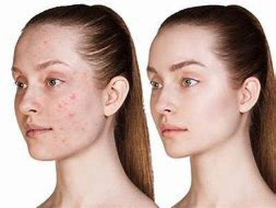 Acne Solution