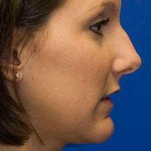 Rhinoplasty in Fort Worth