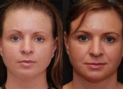 Facial Collagen Injections: The Quick Solution to Your Facial Lines  Summary: If you want to have a youthful skin without going through any cosmetic surgery, facial collagen injections are the easiest ways to get rid of those facial lines