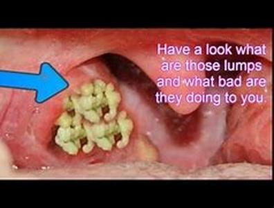 Bacteria - How Acne Develops