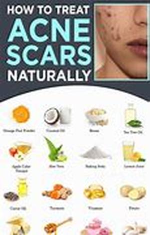 Acne Scars - A Nightmare For Many