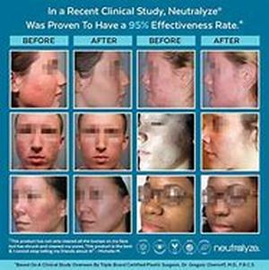 Acne Skin Treatment - 5 Crucial Tips