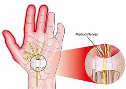 Branches of Carpal Tunnel Therapy