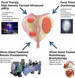 The Value Of A Prostate Cancer Foundation  Many men have suffered from prostate problems especially in their later years