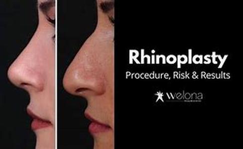 Rhinoplasty For Asians