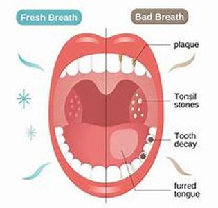 Bad Breath and Gingivitis