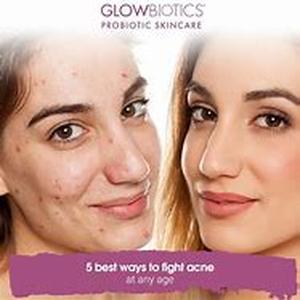 Acne Myths - True or false