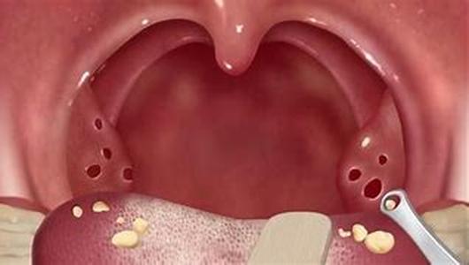 Bacterial Infections : More Than Just Skin Deep