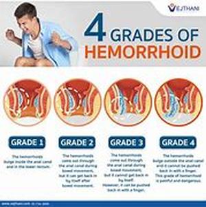 Hemorrhoids - Five Simple Home Remedies