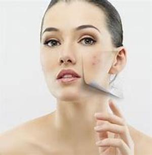 Acne Solutions