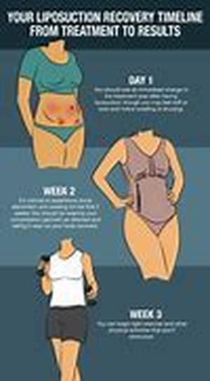 An Overview of Liposuction