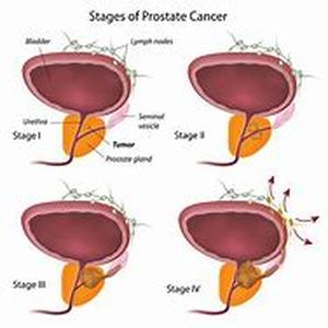 Prostate Cancer Symptoms  Men might be thankful that they dont cervix because they are spared from getting cervical cancer