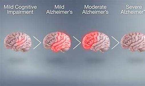 Alzheimers Research