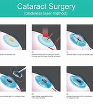 Keyword Phrase: cataract surgery complication