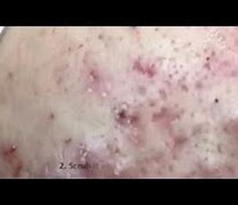 Acne Treatment- How to Take Care of Your Skin