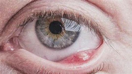 What Is Allergy Induced Asthma