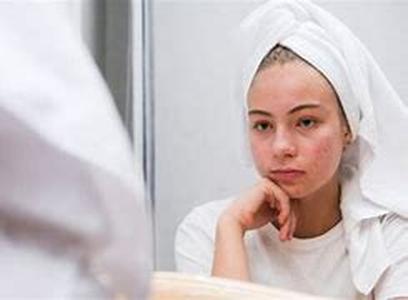 Acne Alternative Treatments