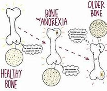 Osteogenic Sarcoma and Back Pain
