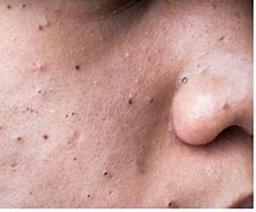 What Is Acne