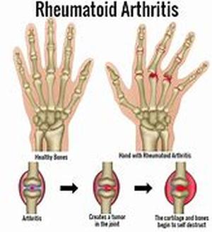 Arthritis Information And Help Is Only A Click Away
