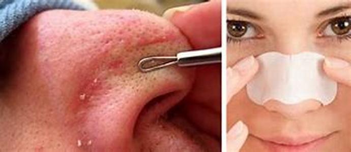 How To Treat Bronchitis