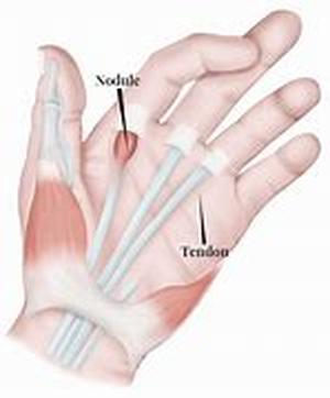 Trichothiodystrophy