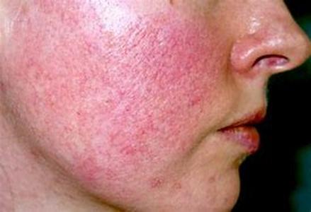 Acne Home Remedies