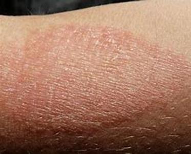 Eczema - MIRACLE or purely Coincidental