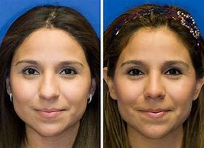 Rhinoplasty in Connecticut