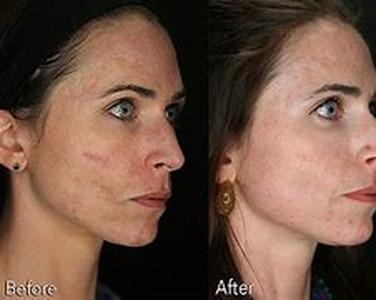 Acne Scars