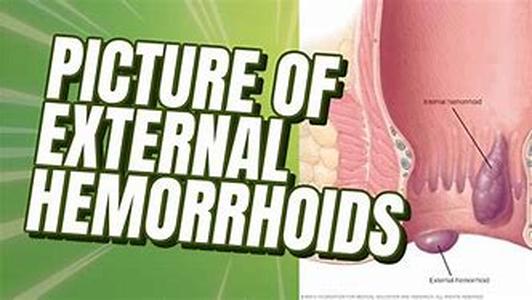 Hemorrhoids: A Real Pain in the Butt